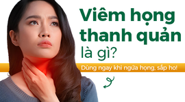 Viêm họng thanh quản là gì: Dùng ngay khi ngứa họng, sắp ho! 