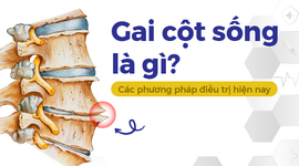 Gai cột sống là gì? Các phương pháp điều trị hiện nay