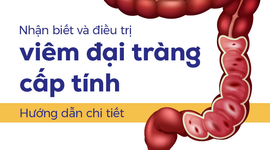 Nhận biết và điều trị viêm đại tràng cấp tính: Hướng dẫn chi tiết