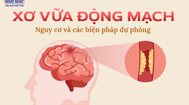 Xơ vữa động mạch: Nguy cơ và các biện pháp dự phòng
