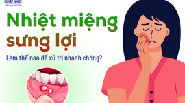 Nhiệt miệng sưng lợi: Làm thế nào để xử trí nhanh chóng?
