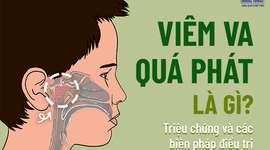 Viêm VA quá phát là gì? Triệu chứng và các biện pháp điều trị 