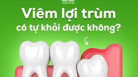 Hỏi nhanh đáp gọn: Viêm lợi trùm có tự khỏi được không? 