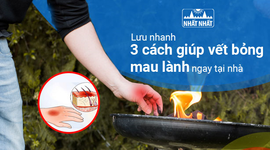 Lưu nhanh 3 cách giúp vết bỏng mau lành ngay tại nhà