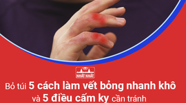 Bỏ túi 5 cách làm vết bỏng nhanh khô và 5 điều cấm kỵ cần tránh