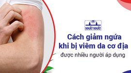 Cách giảm ngứa khi bị viêm da cơ địa được nhiều người áp dụng