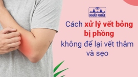 Cách xử lý vết bỏng bị phồng, không để lại vết thâm và sẹo