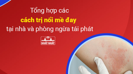 Tổng hợp các cách trị nổi mề đay tại nhà và phòng ngừa tái phát