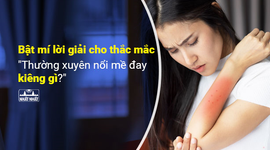 Bật mí lời giải cho thắc mắc “Thường xuyên nổi mề đay kiêng gì?”