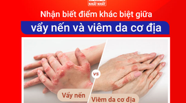 Nhận biết điểm khác biệt giữa vẩy nến và viêm da cơ địa