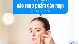 Điểm danh các thực phẩm gây mụn bạn nên tránh