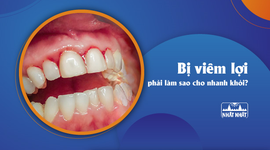 Giải đáp thắc mắc “Bị viêm lợi phải làm sao cho nhanh khỏi?”