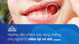 Hướng dẫn chăm sóc răng miệng cho người bị viêm lợi có mủ