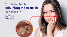 Tìm hiểu nhanh sâu răng hàm có lỗ nên làm gì?