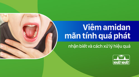 Nhận biết viêm amidan mãn tính quá phát và cách xử lý hiệu quả