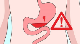 Xuất huyết dạ dày có phải mổ không? Lưu ý chăm sóc sau khi mổ