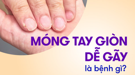 Móng tay giòn dễ gãy là bệnh gì, thiếu chất gì?