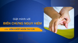 Giật mình với biến chứng nguy hiểm của viêm khớp ngón tay cái