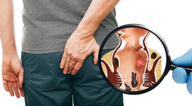 Trĩ hỗn hợp độ 2 có nguy hiểm không? Cách phòng ngừa và điều trị