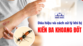 Dấu hiệu và cách xử lý khi bị kiến ba khoang đốt