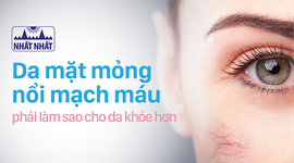 Da mặt mỏng nổi mạch máu phải làm sao cho da khỏe hơn?