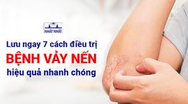 Lưu ngay 7 cách điều trị bệnh vảy nến hiệu quả nhanh chóng