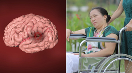 Phòng ngừa tai biến mạch não - cái chết không báo trước - bằng thuốc Đông y thế hệ 2