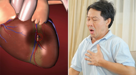 Phòng ngừa và điều trị bệnh mạch vành gây tử vong sau vài phút bằng thuốc Đông y thế hệ 2