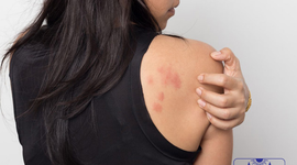 Bật mí các phương pháp điều trị mề đay mãn tính hiệu quả