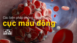 Các biện pháp phòng ngừa cục máu đông một cách tự nhiên