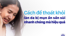 Giải pháp thoát khỏi làn da bị mụn ẩn sần sùi nhanh chóng 