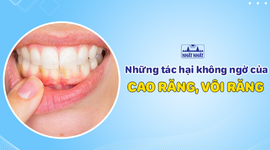 Những tác hại không ngờ của cao răng, vôi răng