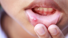 Xử lý nhanh nhiệt miệng ở trẻ em