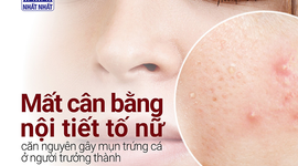 Mất cân bằng nội tiết tố nữ - căn nguyên gây mụn trứng cá ở người trưởng thành