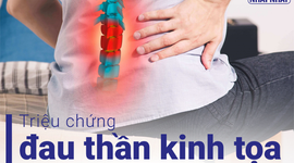 Triệu chứng đau thần kinh tọa phổ biến và các bài tập giảm đau hiệu quả 