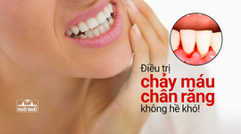 Điều trị chảy máu chân răng không hề khó!