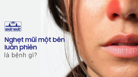 Nghẹt mũi một bên luân phiên là bệnh gì?