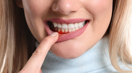 Những nguy hiểm tiềm ẩn khi bị chảy máu chân răng liên tục