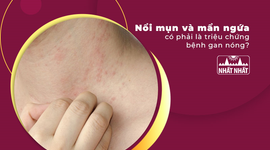 Nổi mụn và mẩn ngứa có phải là triệu chứng bệnh gan nóng?