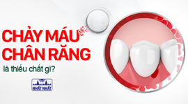 Chảy máu chân răng là thiếu chất gì, điều trị thế nào nhanh khỏi nhất?