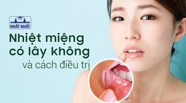 Nhiệt miệng có lây không và cách nào giúp vết loét nhanh lành?