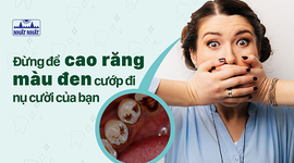 Đừng để cao răng màu đen cướp đi nụ cười của bạn!