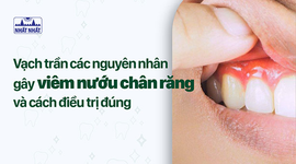 Vạch trần các nguyên nhân gây viêm nướu chân răng và cách điều trị đúng