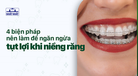 4 biện pháp nên làm để ngăn ngừa tụt lợi khi niềng răng