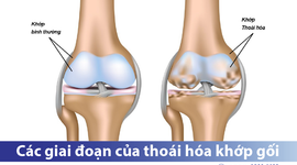 Tìm hiểu 4 giai đoạn của bệnh thoái hóa khớp gối