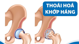 Bệnh thoái hóa khớp háng ở người trẻ: Những thông tin ít người biết