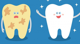 Cách loại bỏ mảng bám trên răng: đơn giản, nhanh chóng, dễ thực hiện