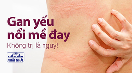 Gan yếu nổi mề đay - không trị là nguy!