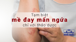 Tạm biệt mề đay mẩn ngứa chỉ với thảo dược đảm bảo hiệu quả