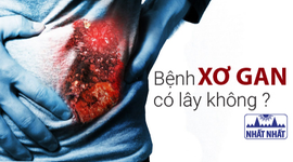 Bệnh xơ gan có lây không? Làm sao để phòng ngừa và điều trị hiệu quả?
